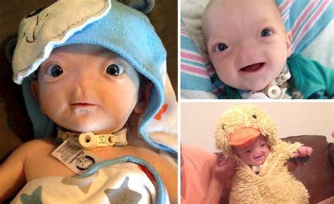 Baby Born Without A Nose Is The Internet's Happiest, Most Adorable Baby ...