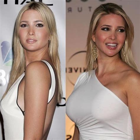 Ivanka Trump - fashion model uses Plastic Surgery?