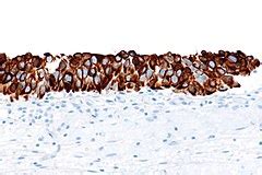 Urothelial carcinoma in situ - Libre Pathology