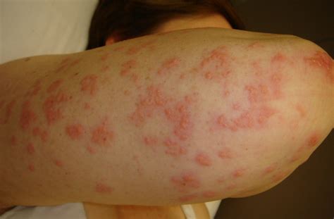 Dermatitis Herpetiformis – Gejala, Penyebab, Dan Cara Mengatasi Yang Wajib Anda Ketahui