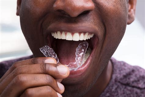 Invisalign London | Invisible Braces London | Ten Dental