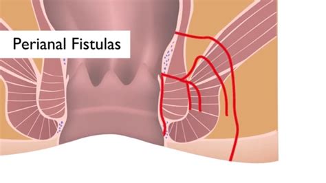 Fistula - 131 Fistula Illustrations Clip Art : Treatment options include medications, surgery ...