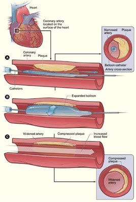 Koronární Angioplastika a Stenting | kardiochirurgie | Michigan ...