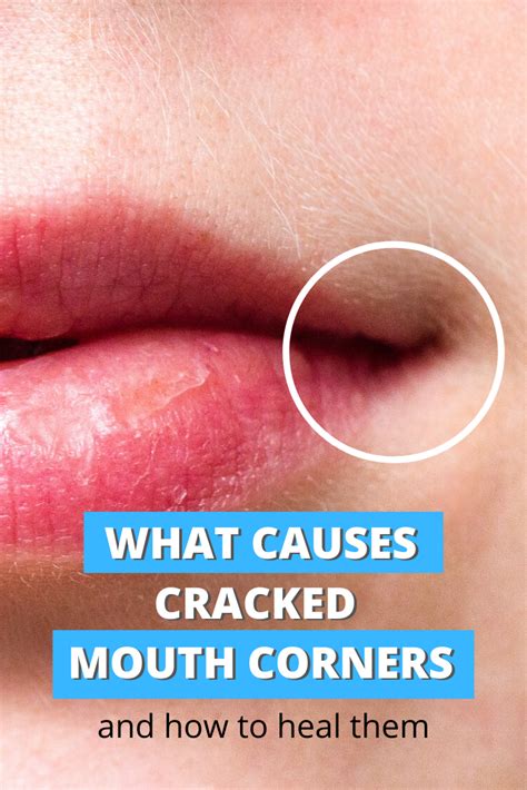 CRACKED LIP CORNERS - what causes them and how to heal fast | Cracked lips, Cracked corners of ...