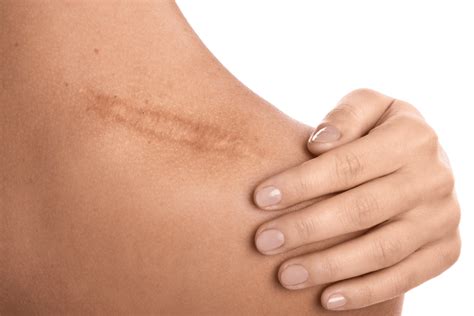 Can Red Light Therapy Help with Scars? - The Energy Blueprint