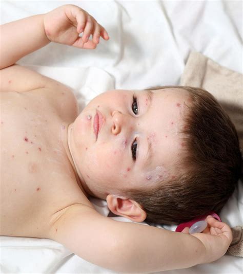 Scabies In Toddlers – Causes, Symptoms & Treatments You Should Be Aware Of