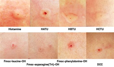 Histamine Allergy