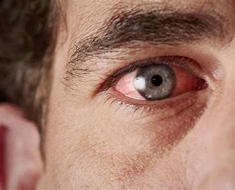 Red Eyes: Causes, Symptoms & Treatment | Goyal Eye