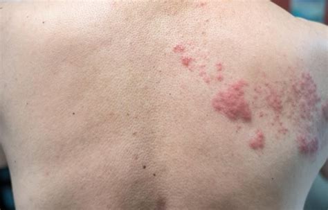 Shingles Herpes Zoster Rash On Hand Stock Photo Alamy - vrogue.co