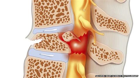 Spinal cord injury may respond to cancer drug - BBC News