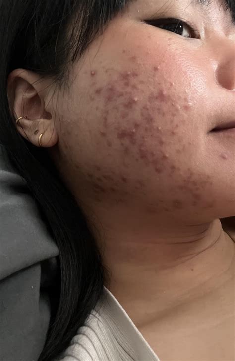 Differin purging (week 6) : r/acne