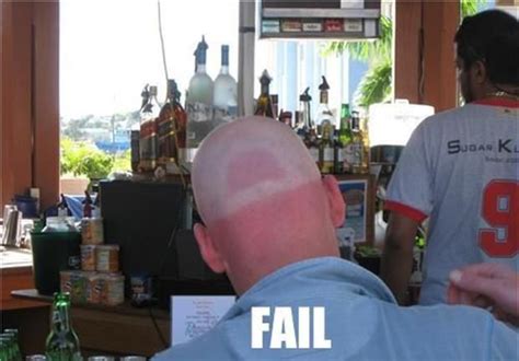 21 Funny Sunburn Pictures | Funny sunburn, Funniest fails ever, Funny ...