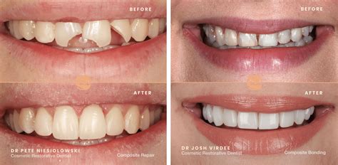 How Composite Bonding can fix crooked teeth | Ruh Dental