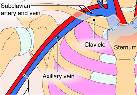 The Subclavian Line: The Resuscitation Line of Champions — Downeast ...