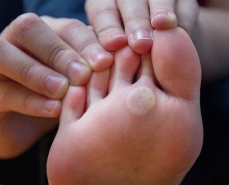 Plantar Warts: Symptoms, Causes, And Treatment, 54% OFF