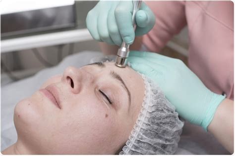 What is Dermabrasion?