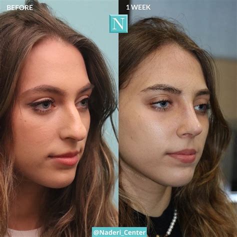 Nose Job Before & After | The Naderi Center in 2023 | Nose job, Rhinoplasty nose jobs, Rhinoplasty