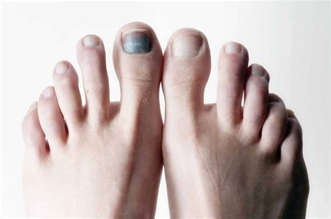 Black Toenail Cancer: Things You Must Know - Nedufy