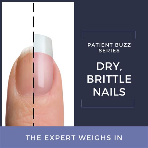 Patient Buzz: Dry, Brittle Nails The Expert Weighs In Next