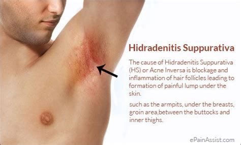 Pin on hidradenitis-suppurativa-hs-or-acne-inversa