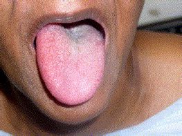 Angiotensin-converting enzyme inhibitors as a cause of unilateral tongue angioedema in a 68-year ...