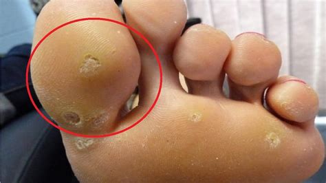 how to get rid of plantar warts with duct tape fast and easy - YouTube