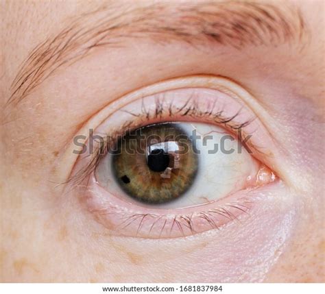 Brown Eye Nevus On Iris Stock Photo 1681837984 | Shutterstock