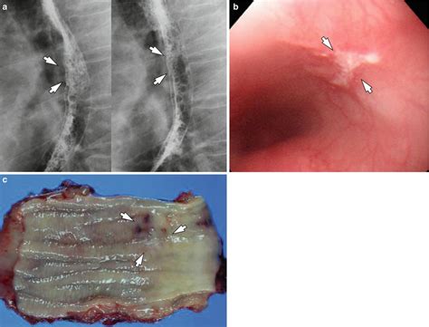 Premalignant And Malignant Lesions Of The Esophagus A | Sexiz Pix