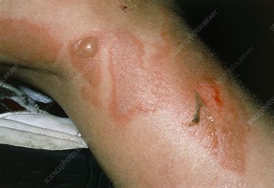 Ritter's disease or scalded skin syndrome on child - Stock Image - M250/0035 - Science Photo Library