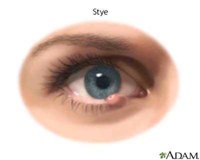 Stye (Hordeolum) - Symptoms and Causes | Penn Medicine