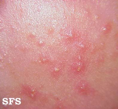 Neonatal acne - wikidoc