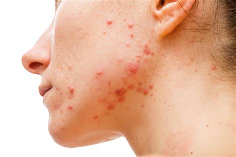 Acne | Blackheads | Pimple | Zits | MedlinePlus