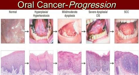 The Warning Signs & Symptoms of Mouth Cancer | Emergency Dentist Brooklyn NY