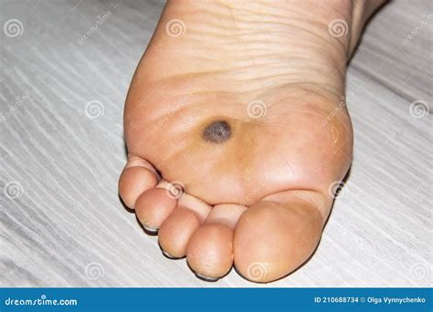 Plantar Wart On Big Toe. Visible Black Dots Warts. Royalty-Free Stock ...