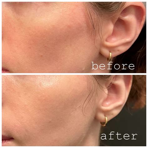 Skinvive Before and After: Real Photos