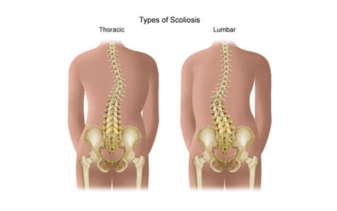 Scoliosis Pain – Downtown Toronto Chiropractor