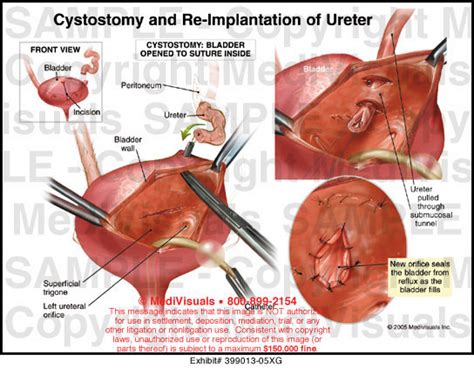 Ureteral Opening