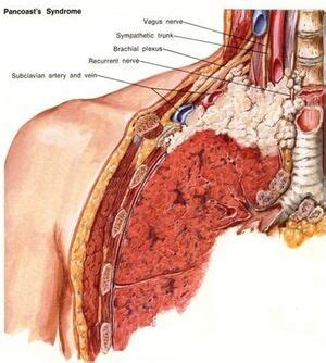 Anatomy Of A Tumor