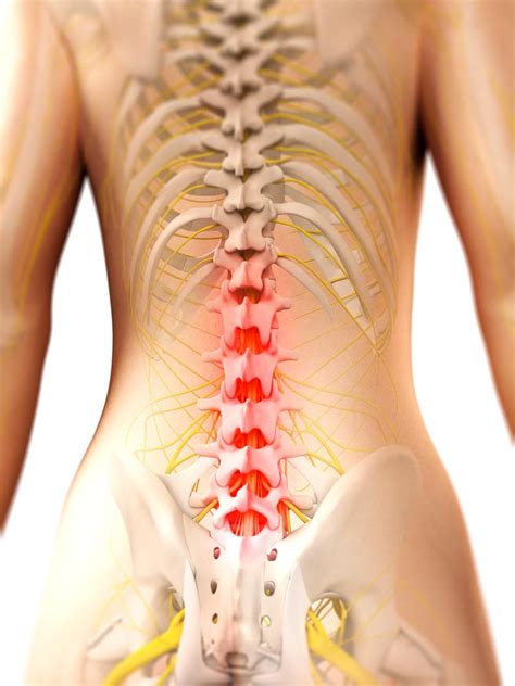 Pinched Nerve (Cervical Radiculopathy) | Ohio State Medical Center