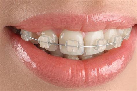 Types of Braces – Orthodude