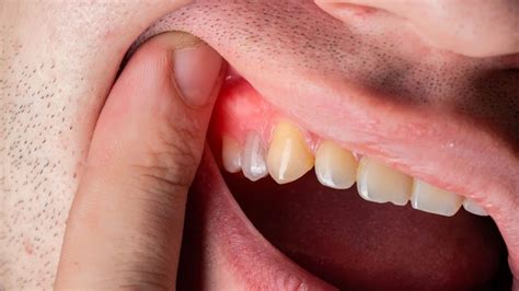 11 Home Remedies For Swollen Gums