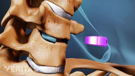 Cervical Discectomy And Fusion