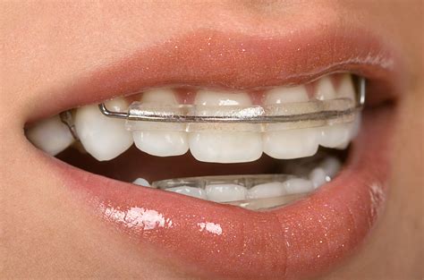 Dental Braces - Sommers Family Dentistry Blog Sommers Family Dentistry Blog
