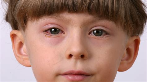 What Is Pink Eye? Causes, Symptoms, and Treatment for Conjunctivitis - GoodRx