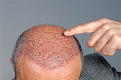 Biofibre Hair Transplant In Dubai - Dr Abbas Ashrafzadeh