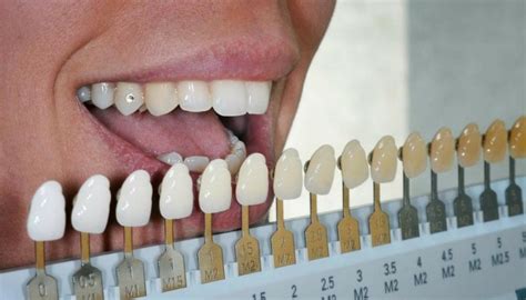 WHAT DOES THE COLOUR OF YOUR TEETH HAVE TO SAY ABOUT YOU? | HealthGist.Net