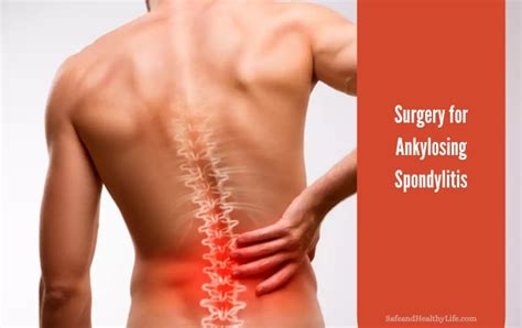 Surgery for Ankylosing Spondylitis | SHL