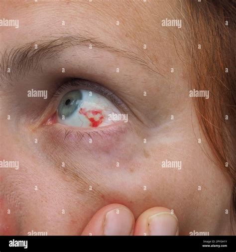 Subconjunctival hemorrhage or subconjunctival bleeding, hyposhagmus ...