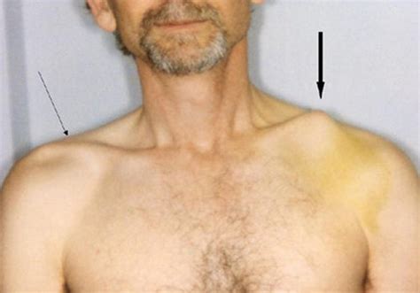 👉 Collarbone pain (clavicle pain) - Causes and Treatment (November 2021)