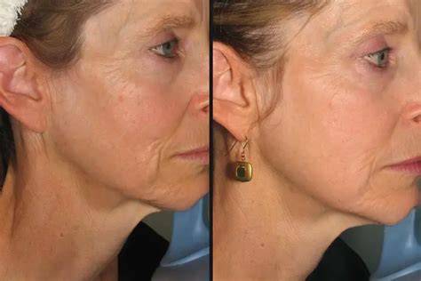 Skin Tightening Laser Treatment: How It Works, Pros and Cons